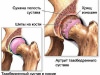 Эндопротезирование в Израиле